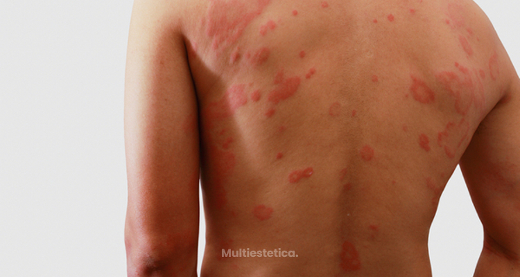 conoce los tipos de dermatitis multiestetica mx