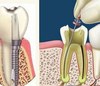 Extracción de dientes y endodoncia