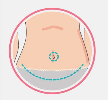 Abdominoplastia paso por paso - Multiestetica.mx